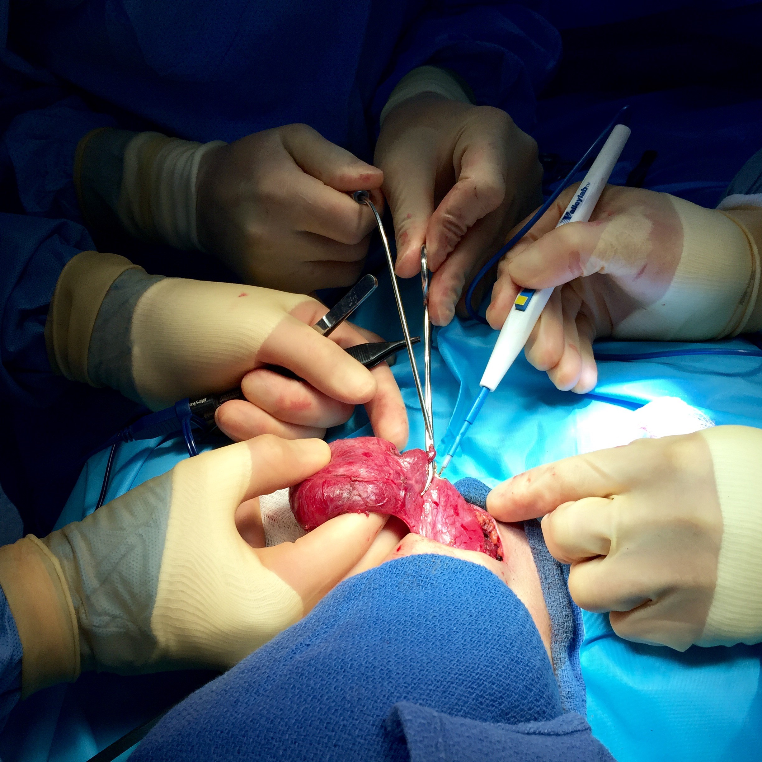 The Head and Neck Surgery team removing a thyroid goiter from a petite woman’s neck. 